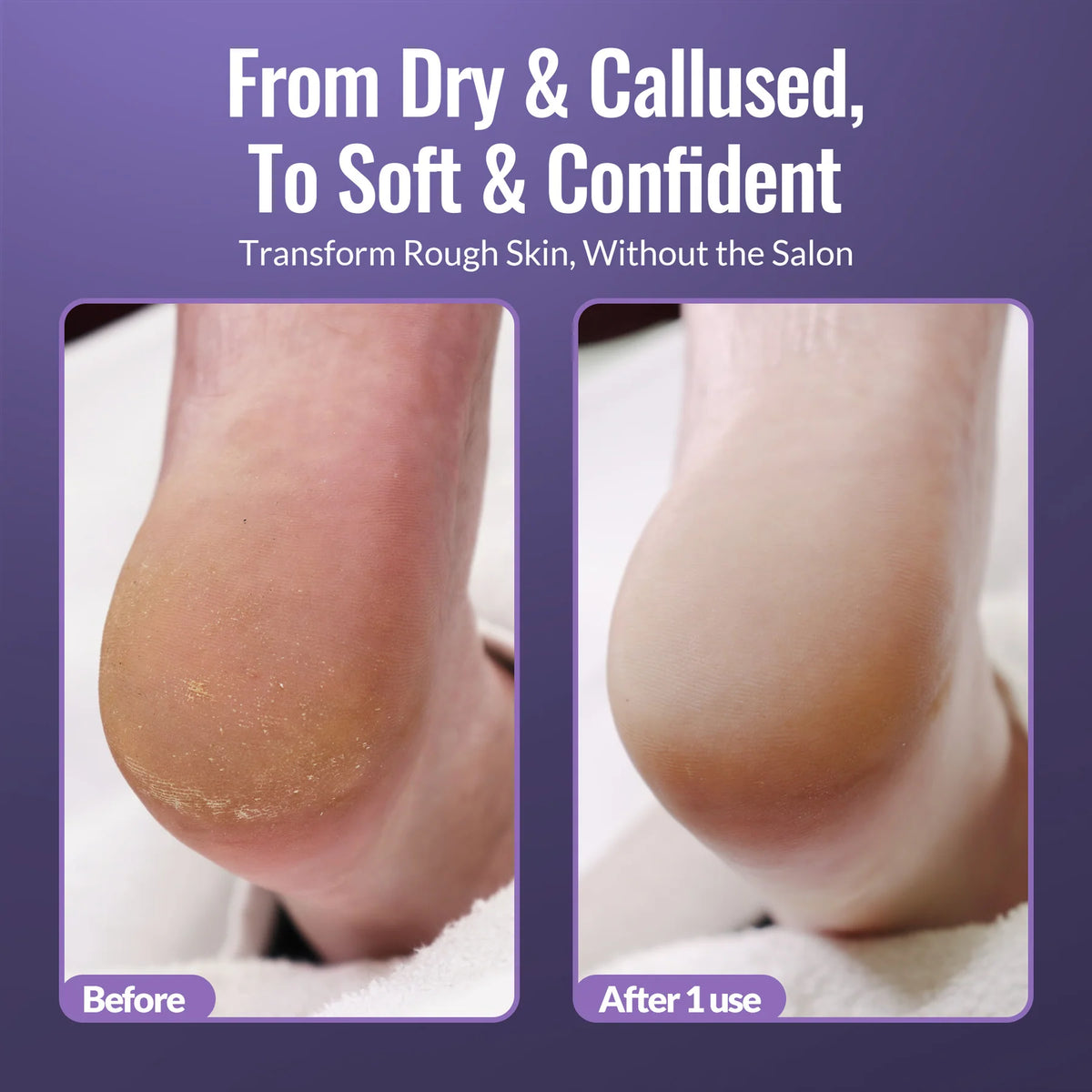 Ultimate At-Home Foot Care Combo – Callus Softener & Foot File